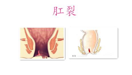 肛裂诊疗技术研究新进展探索与展望